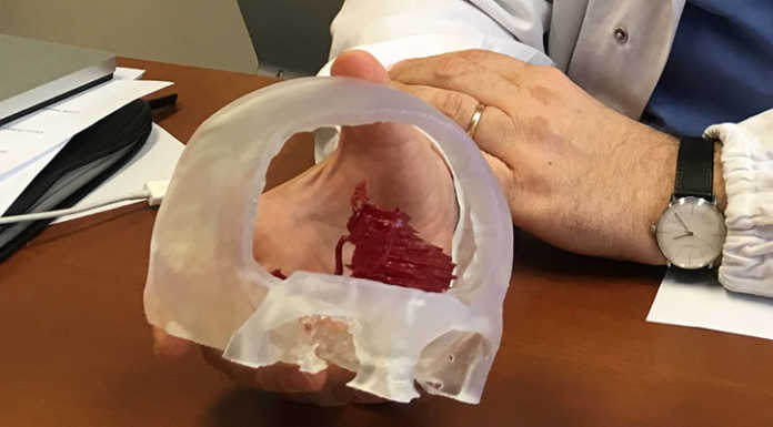 Aneurisma ‘gigante’ operato a Lecco. Stampa 3D in supporto ai chirurghi