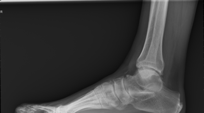 Fisio Online. Ho una spina calcaneare: devo preoccuparmi?