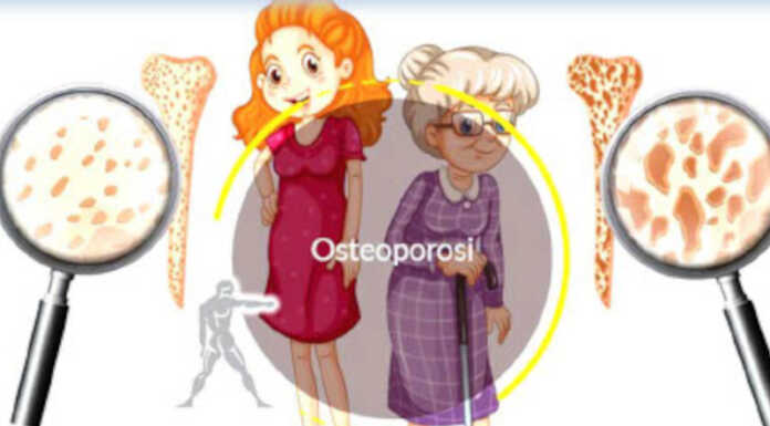 Serate Salute dell’Avis Calolzio: si parla di osteoporosi col dottor Fezzi Osteoporosi serate salute avis calolzio