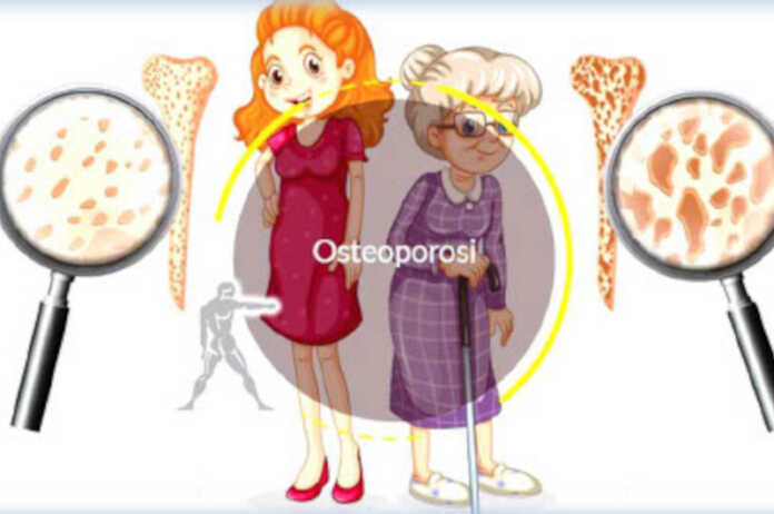 Osteoporosi serate salute avis calolzio